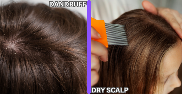 DANDRUFF vs DRY SCALP